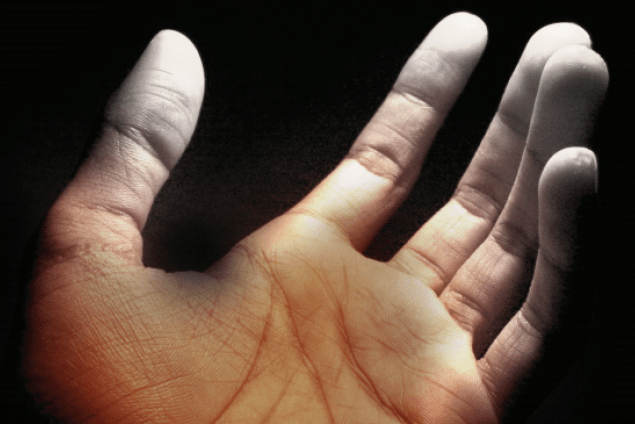 Mãos com Síndrome de Dedo Branco